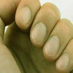 ingrown fingernail